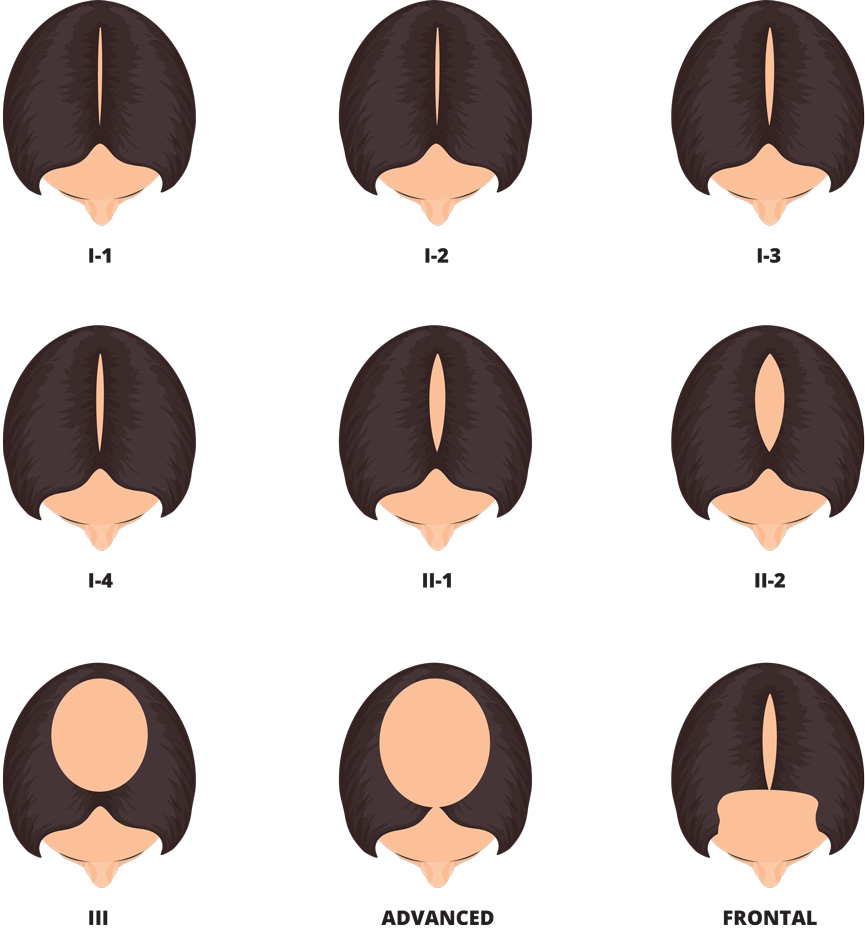 Female Hair Loss Solutions International Hair Studio