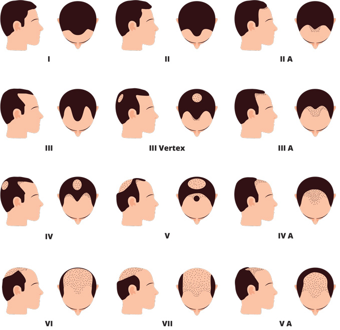 Male pattern baldness | International Hair Studio