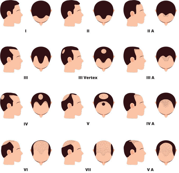 Male pattern shop hair loss