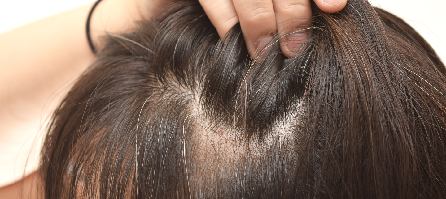Signs your hair is thinning | International Hair Studio