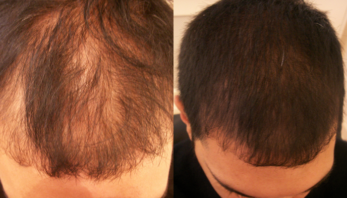 thinning hair top of head