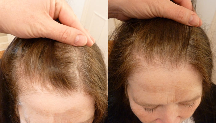 Thinning Hair at Temples After Using Minoxidil for 15 Years