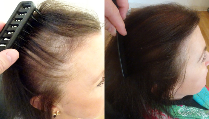 Laser Hair Treatment