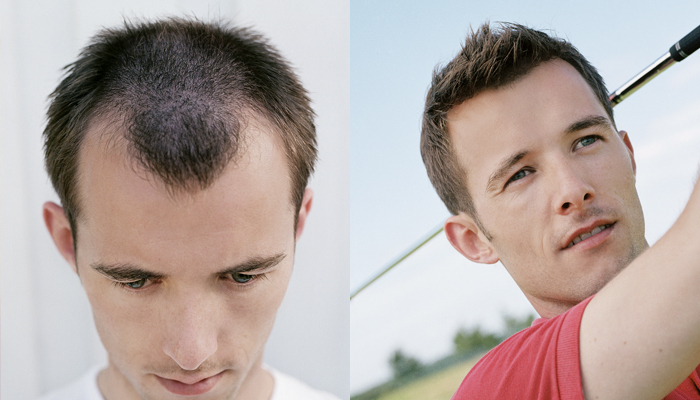 early male pattern baldness