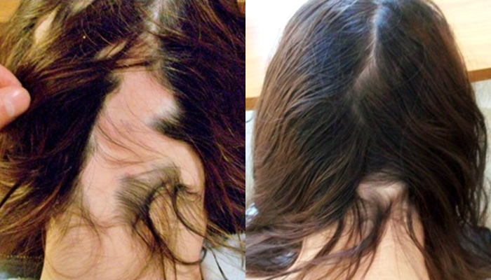 Patches of hair loss | International Hair Studio