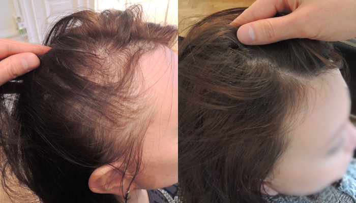 What are the Best Hairstyles for Traction Alopecia? – Equi Botanics