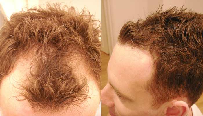 Hair Transplant for Receding Hairline in Islamabad Pakistan | SKN Clinic