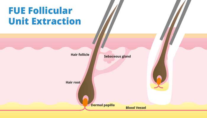 hair transplant