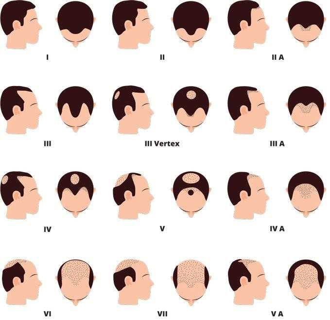 hair loss in men